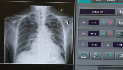 X-ray Report of patient at ER